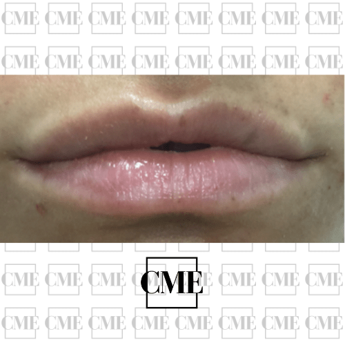 Ácido hialurónico labios antes
